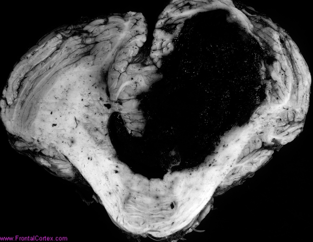 Hypertensive cerebellar hemorrhage